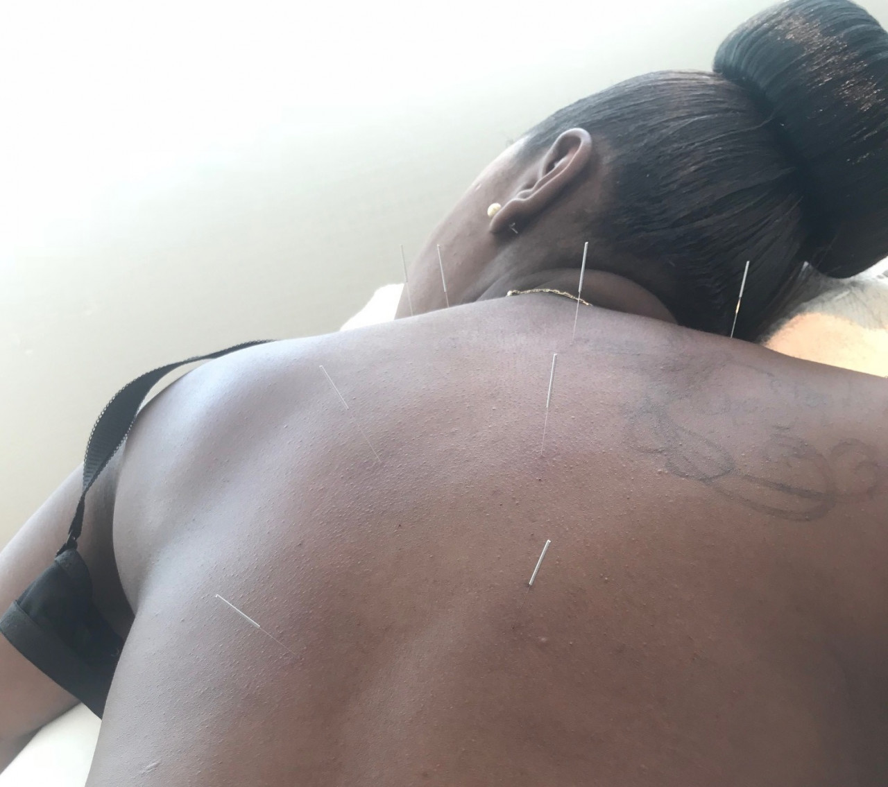 鍼（acupuncture ）